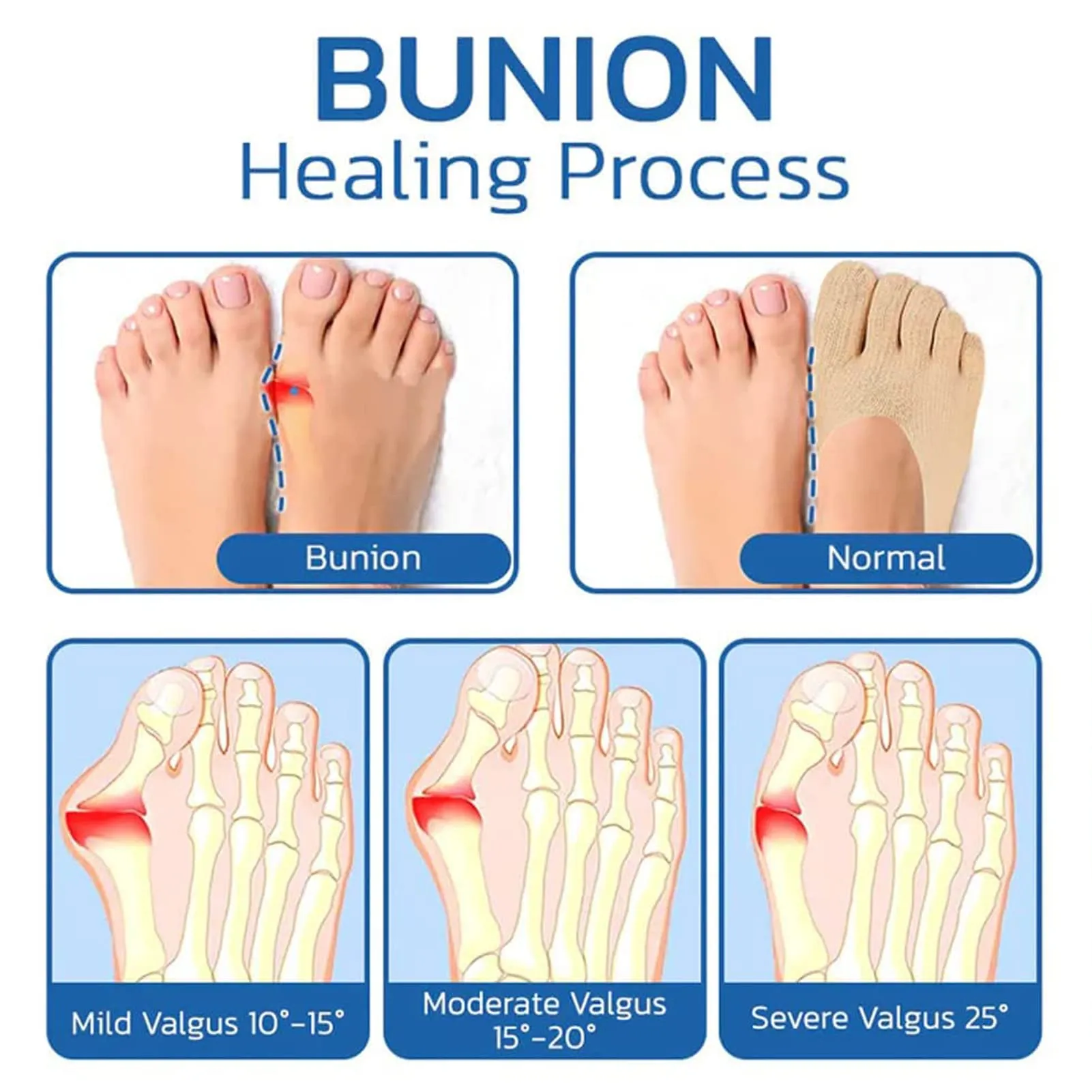 5 Pairs Sock Align Toe Socks for Bunion, No Show Low Cut Five Finger Orthopedic Compression Socks For Women (Toe Socks-B) Toe Socks-B