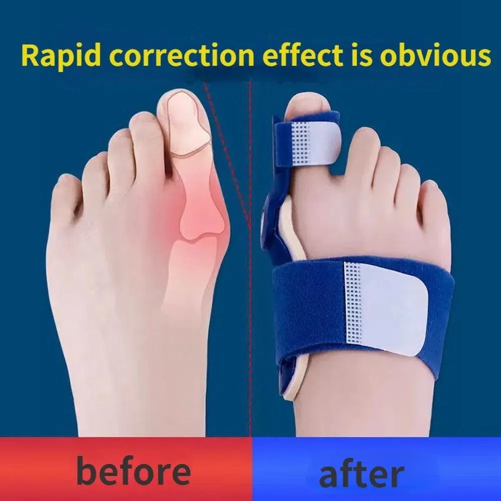 Big Toe Bunion Splint Set: Correct Foot Alignment, Relieve Pain